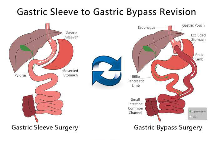 Revision Surgery