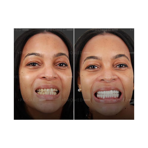 lady teeth restore image