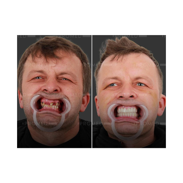 white male teeth restore image