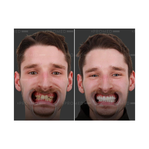 white male teeth restore image